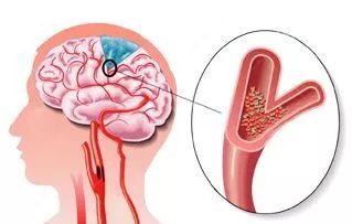 择思达斯：什么是脑卒中