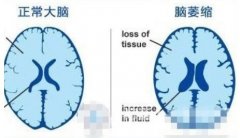 预防脑卒中要做些什么