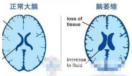 预防脑卒中要做些什么