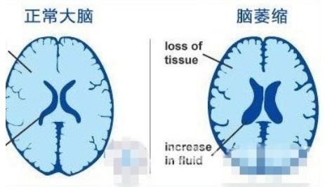 脑卒中的治疗用经颅磁刺激仪治愈