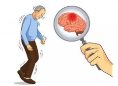 身体出现这3种现象要注意脑卒中