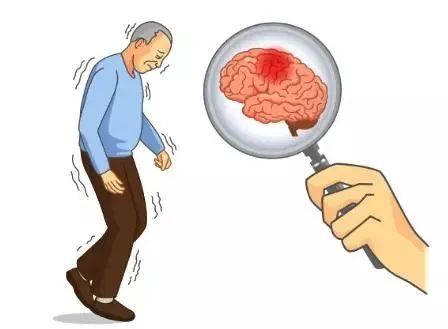身体出现这3种现象要注意脑卒中